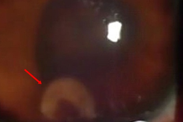 Gözüne giren kurt retinasını deldi