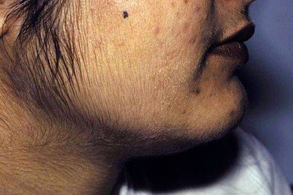 Ayva tüylerinden bu şekilde kurtulabilirsiniz