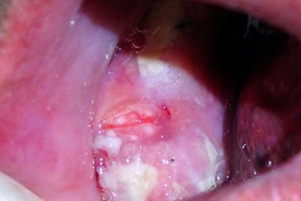 Dikkat: Ağzınızda bu belirtiler varsa...