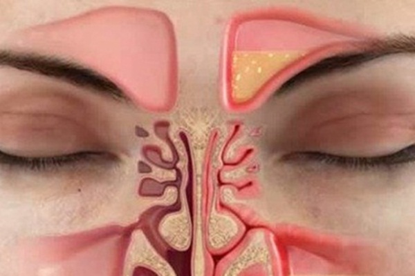 Burun tıkanıklığından bir dakikada kurtulun