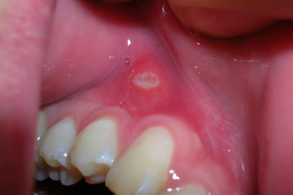 Aft çıkarsa bunları yapın