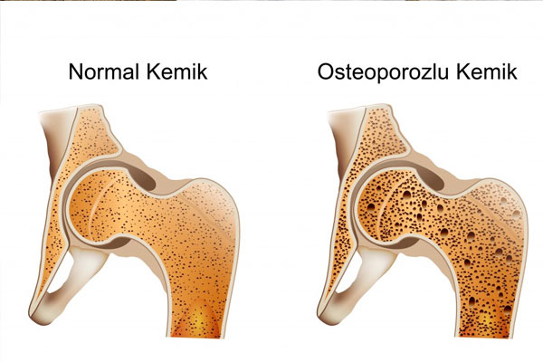 Kemik erimesi artık daha kolay