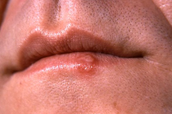 Uçuk nasıl geçer?