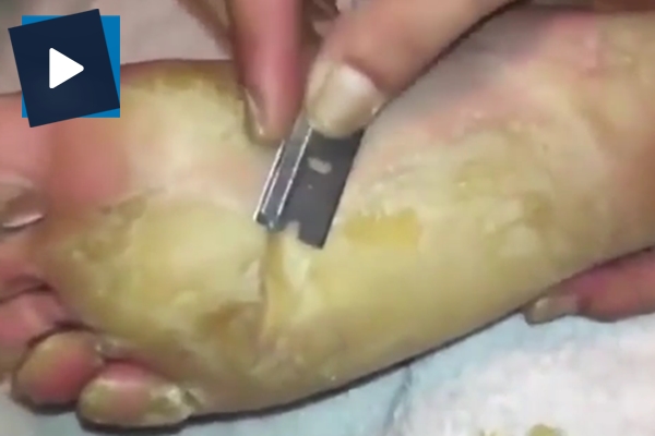 Adam ayağındaki nasırları jiletle kesti