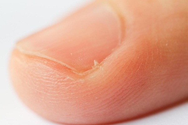 Şeytan tırnağına bal sürmenin faydası