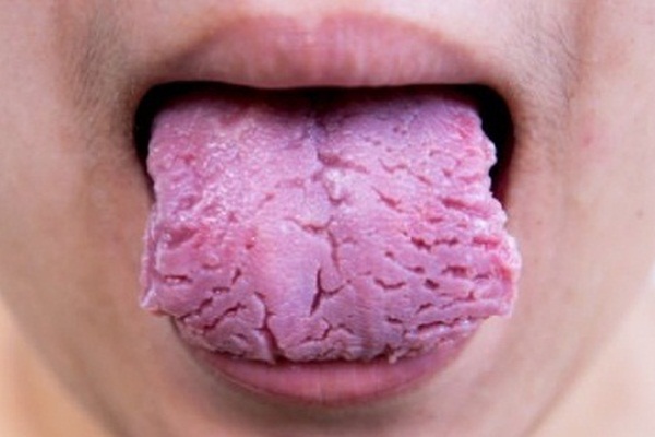 Dildeki yaralar kanserin habercisi olabilir