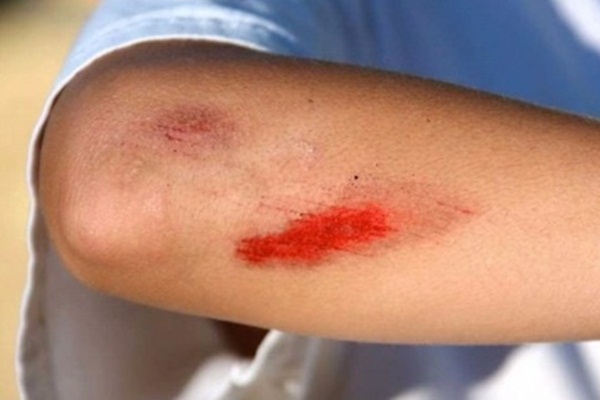 Yaralar kanserin habercisi olabilir