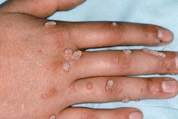 Siğillere muz kabuğu koyarsanız...