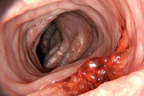 Bağırsak kanserine dikkat