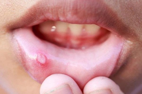 Ağzın içinde çıkan yaralara dikkat