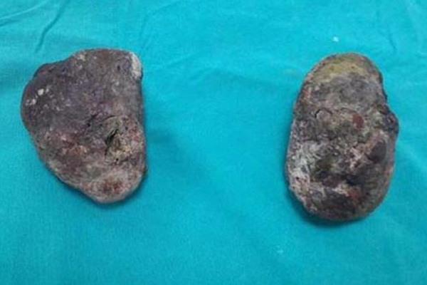 1,5 kilo Trabzon hurması yedi, midesinden bu çıktı