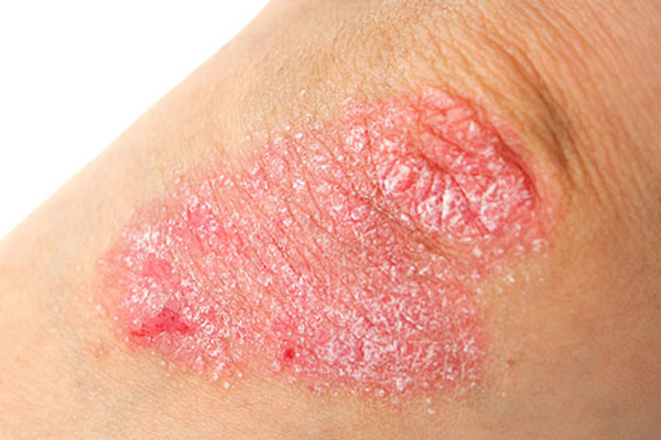 Soğuk ve rüzgarlı hava egzamayı artırıyor