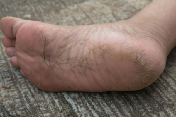 Topuk çatlakları ölümcül hastalığın belirtisi!