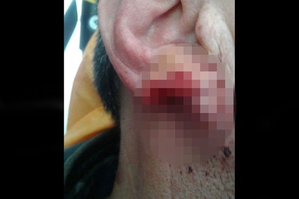 Kavga ettiği şahsın kulağını kopardı