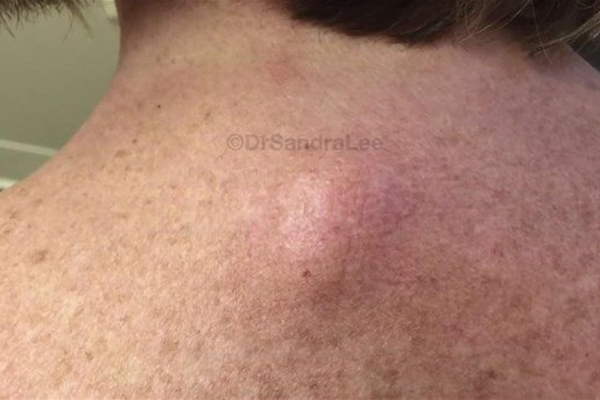 Boynundaki kisti kesti ve...