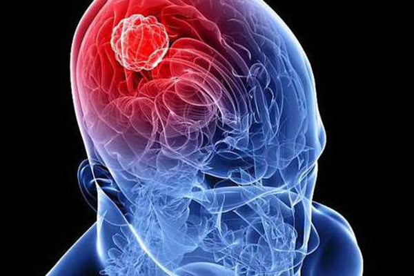 Beyninden 1 kilogram 873 gram tümör çıktı