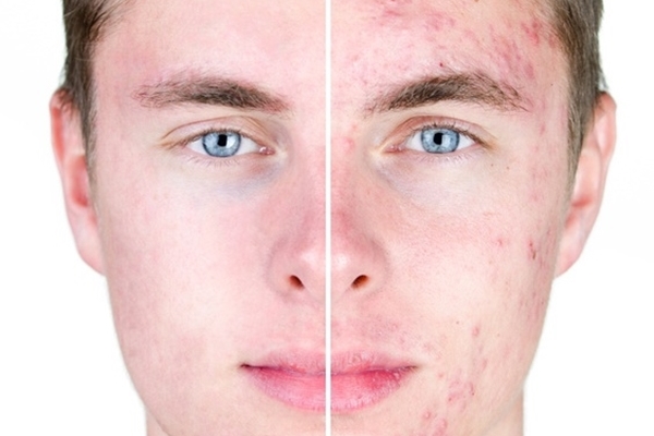 Sivilceye bunlar sebep oluyor!