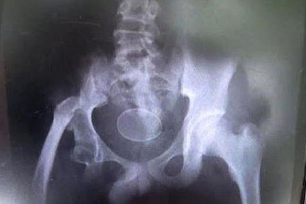 Tavuk gibi yumurtlayan çocuk görenleri şaşkına çevirdi