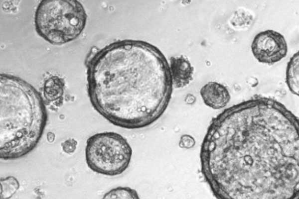 Kanserle mücadele için küçük tümörler üretildi