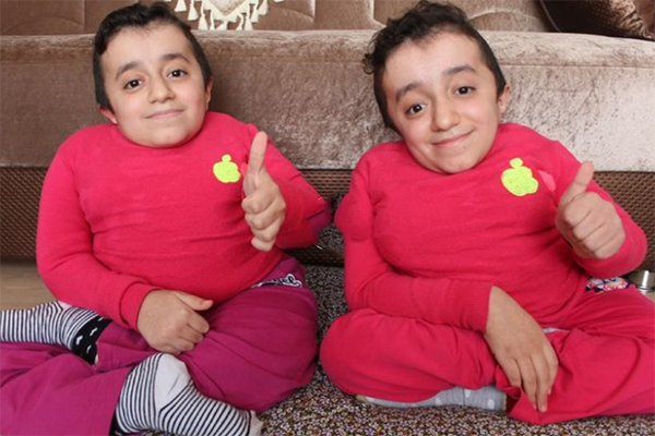 Doğuştan cam kemik hastası ikizler yardım bekliyor