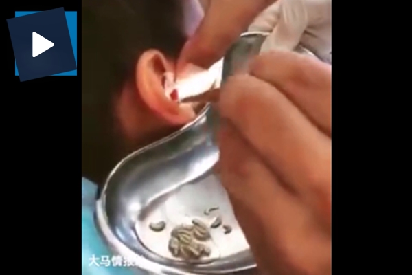 Doktorlar kulağın içindekine inanamadı!