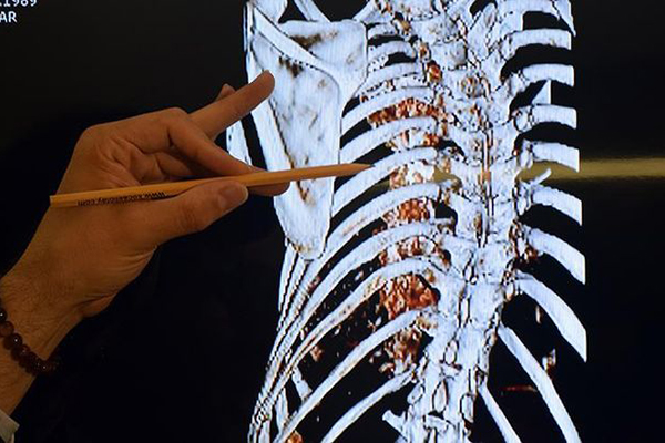 'Sinir dokusu mühendisliği' hastalara umut olacak