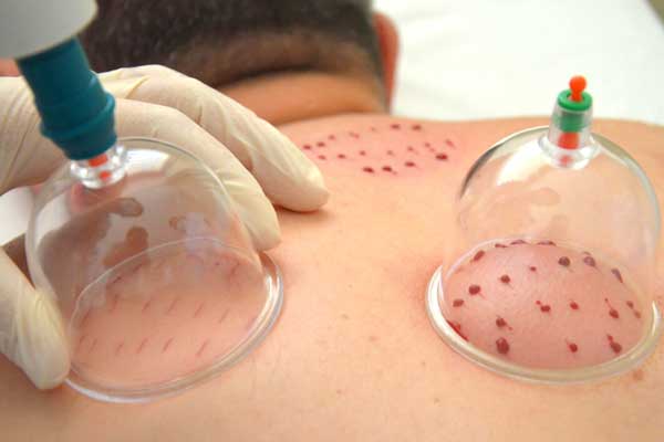 Sağlık Bakanlığı: Hacamatı aile hekimleri yapacak