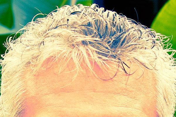 Kalp damar hastalıkları saçlara ak düşürüyor