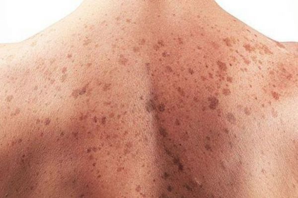 Deri kanserinin teşhisinde bilgisayar insana göre daha başarılı