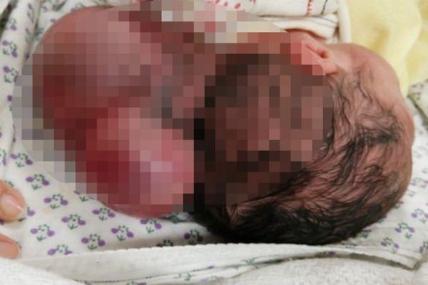 Hatay’da iki kafalı bebek dünyaya geldi