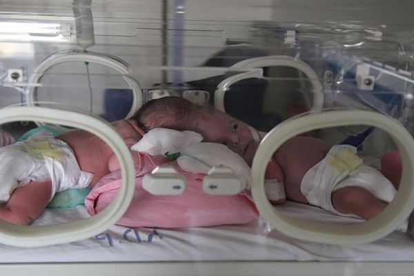 Siyam ikizlerinin biri 'Yiğit' diğeri 'Derman'