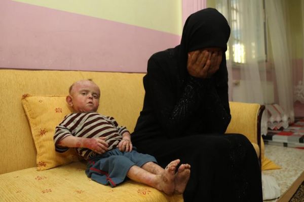 Suriyeli Yezan'ın yaraları Türkiye'de sarılacak