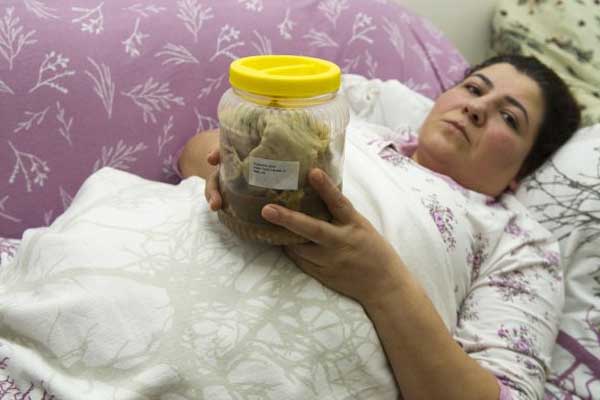 Karnında 1.8 kilo gazlı bez unutuldu