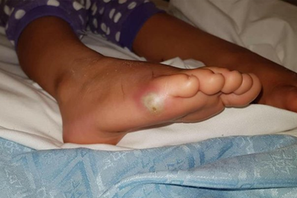 Denediği ayakkabıdan zehirlendi