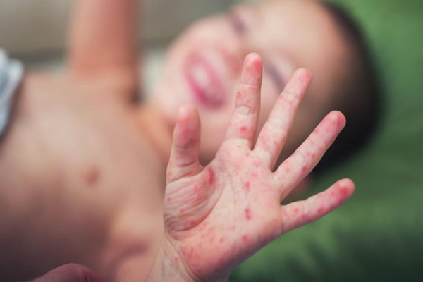 Endonezya'da kızamıkçık salgını nedeniyle 49 öğrenci karantinaya alındı