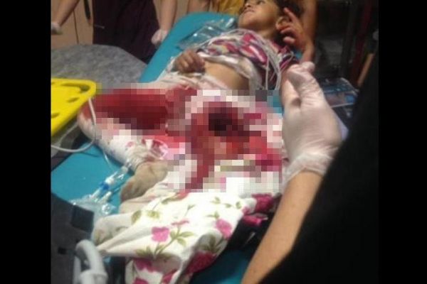 Küçük kız bacağını patoza kaptırdı