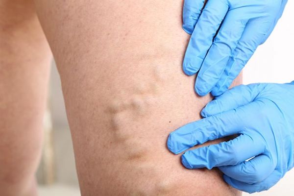 Varis ölümcül bir hastalığa dönüşebilir