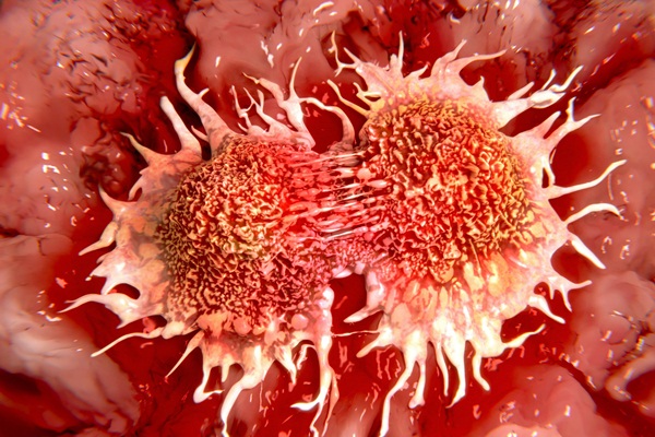 Tek donörden dört hastaya kanser nakli