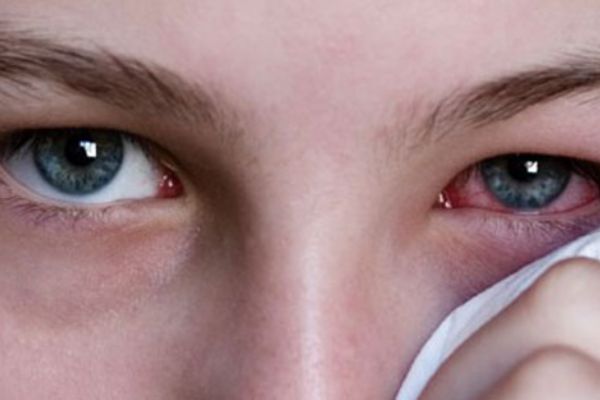 Sakın hafife almayın! Bu salgın gözlerde...