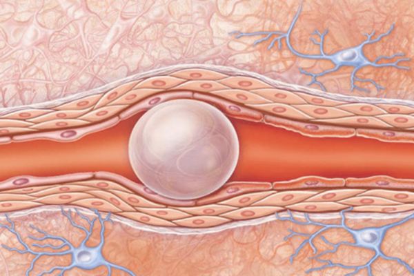 Yağ embolisi sendromu nedir? Belirtileri nelerdir? Tedavisi var mıdır?