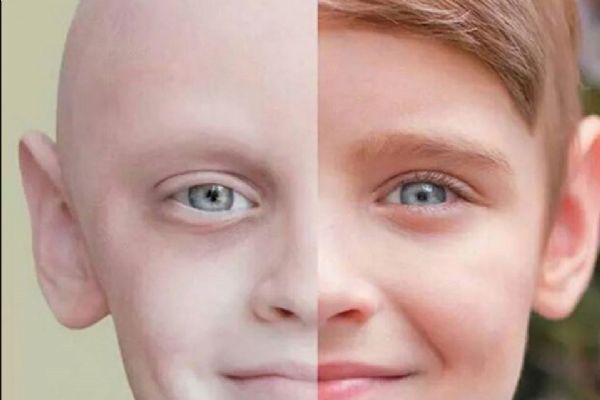 Löseminin bilinmeyen 9 belirtisi