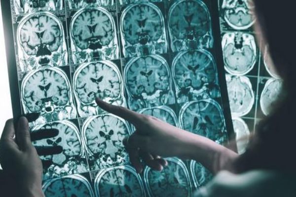 Beyin kanseri görülebilir mi