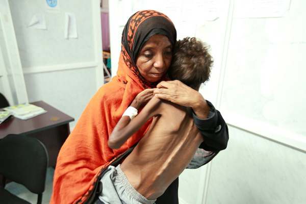 ‘Yemen'de 85 bin çocuk yetersiz beslenmeden ölmüş olabilir’