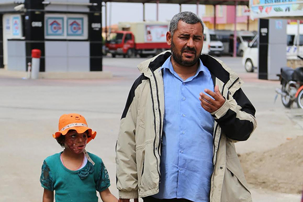 Suriyeli Emira'nın yüzündeki savaşın izleri silinecek - 3