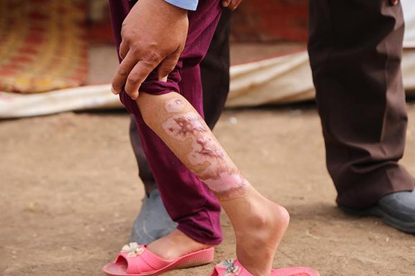 Suriyeli Emira'nın yüzündeki savaşın izleri silinecek - 2