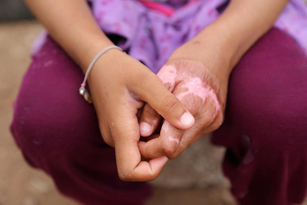 Suriyeli Emira'nın yüzündeki savaşın izleri silinecek - 9