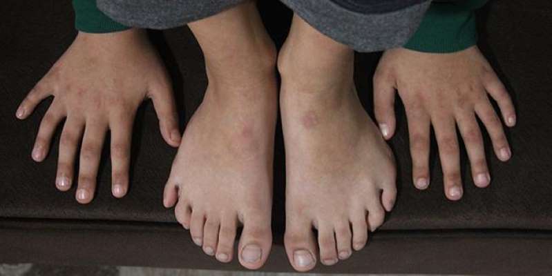 24 parmaklı çocuk için vali devreye girdi - 1