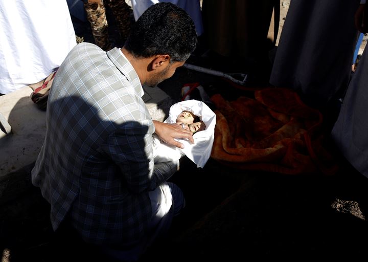 Yemende yeni doğan yapışık ikizler hayatını kaybetti - 2