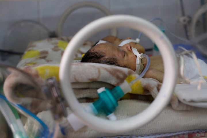 Yemende yeni doğan yapışık ikizler hayatını kaybetti - 4