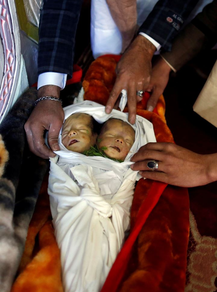 Yemende yeni doğan yapışık ikizler hayatını kaybetti - 7